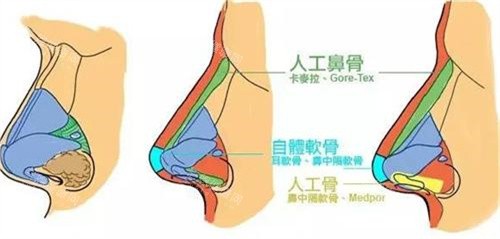 隆鼻手术对比