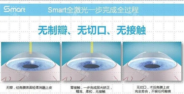 smart全激光手术过程
