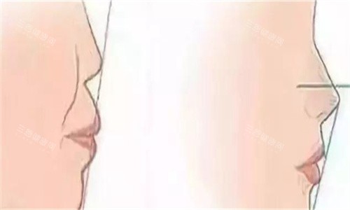 隆鼻前后侧面对比