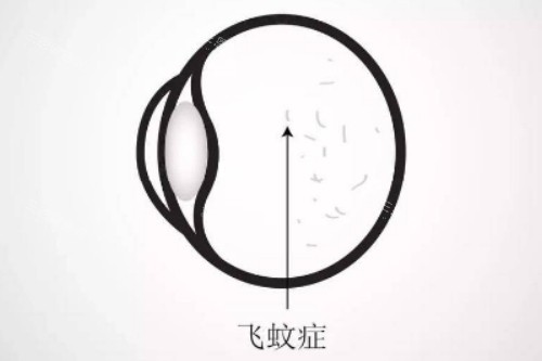 飞蚊症卡通图片展示