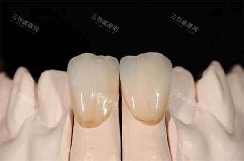 铸瓷冠