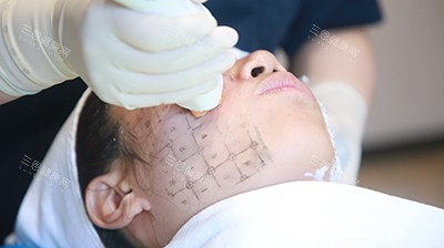 热玛吉抗衰 热玛吉抗衰