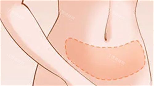 腹部吸脂成效展示图
