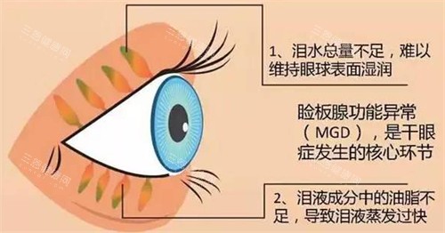 睑板腺疏通作用