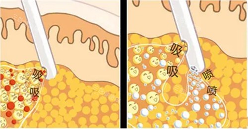 昆明韩辰陈宁吸脂术后会反弹吗？脂肪存活率与长期维护指南！