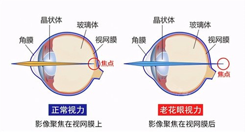 老花眼和正常视力