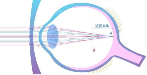 离焦镜片原理 离焦镜片原理
