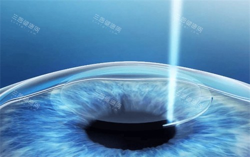 邢台人民医院眼科收费价格表查看，近视矫正11500起/白内障4300起/OK镜5500起！