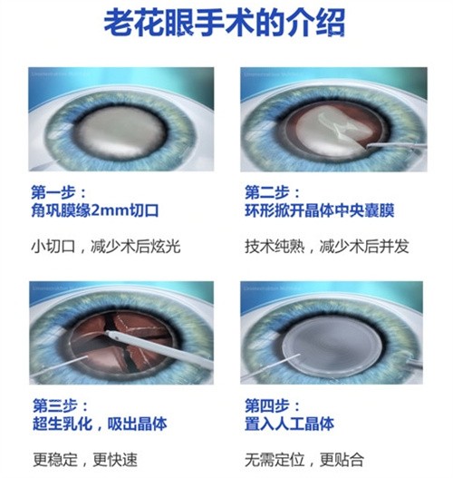 老花眼手术的介绍 老花眼手术的介绍