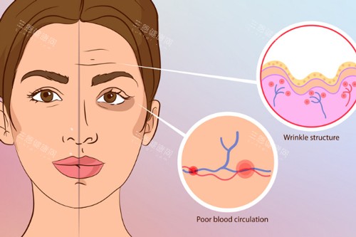 注射玻尿酸前后对比 注射玻尿酸前后对比