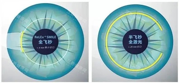 辽宁爱尔眼科近视眼手术收费公开，分享2025年做半飞秒/全飞秒/ICL晶体植入费用标准！