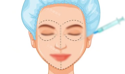 玻尿酸全脸填充展示 玻尿酸全脸填充展示