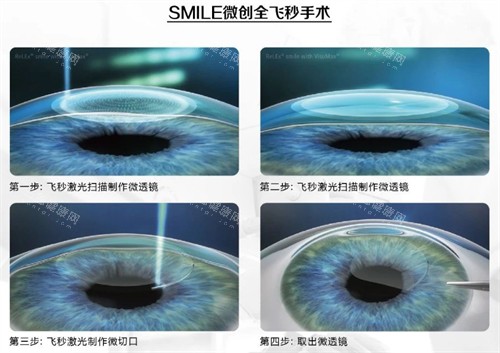 艾维眼科收费价目表一览：白内障3000+/全飞秒14800+/晶体植入27000+/OK镜6800+