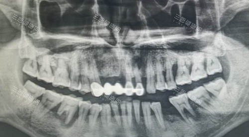 口腔缺牙ct