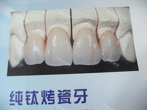 25年做一颗牙冠多少钱？全瓷牙冠、烤瓷牙冠价格表供你参考