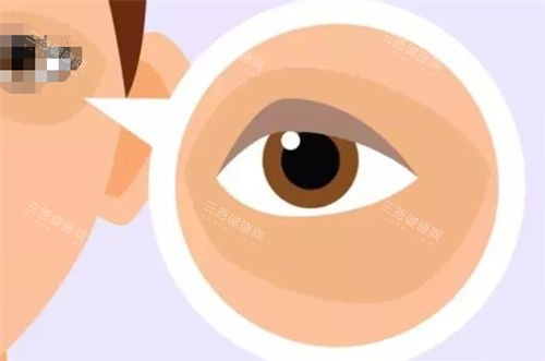 黑眼圈眼袋示意图