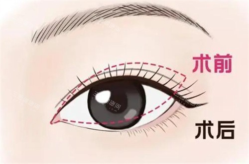 南京华韩奇致裴炳万修复双眼皮技术解析：显微操作+分层缝合，闭眼无痕自然灵动~