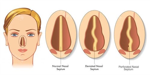 鼻矫正过程 鼻矫正过程