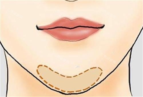 玻尿酸丰下巴的位置 玻尿酸丰下巴的位置