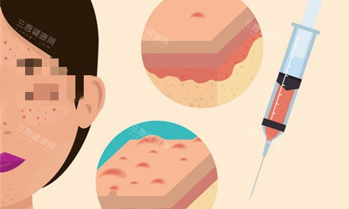 面部改善注射图 面部改善注射图