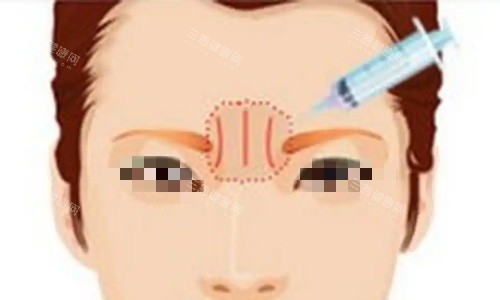 川字纹注射示意图 川字纹注射示意图