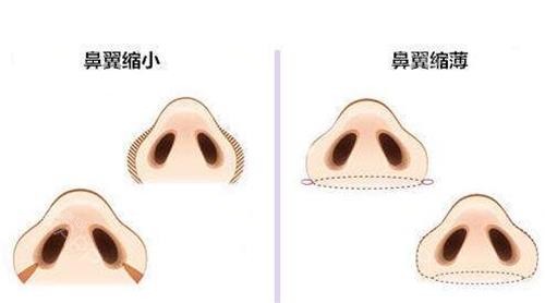 汉中华美奥莱鼻翼缩小