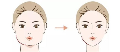 汉中华美奥莱瘦脸手术前后对比动画图