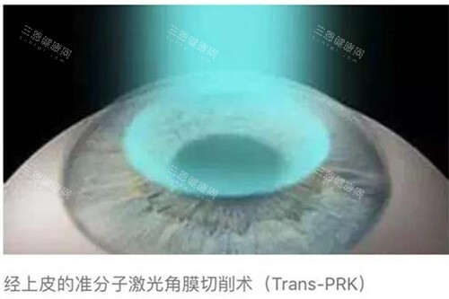 近视眼手术示意图