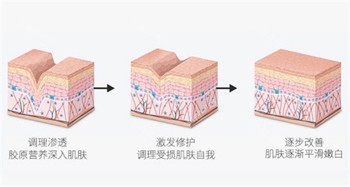 医美新趋势|天使针骨胶原支架值不值得做?型号选择指南+维持时效&代谢风险深度揭秘