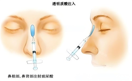 宜昌隆鼻哪家好？蕾蒂|伊莱美|前卫做鼻子侧脸杀还不怕揉捏