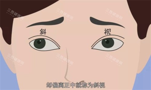 斜视手术后悔？真实经历分享：术前没搞清楚这 3 点，难怪有人术后不满意！