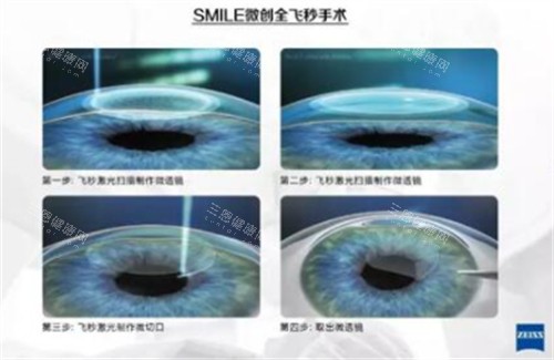 鲁南眼科医院2025年收费价目表更新：近视矫正12800+|白内障6800+|斜视矫正5800+