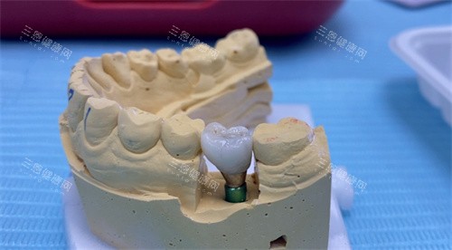杭州口腔种植牙医院排名：团圆口腔/修元口腔/尚佳口腔/科瓦口腔/艺星口腔5家排在前