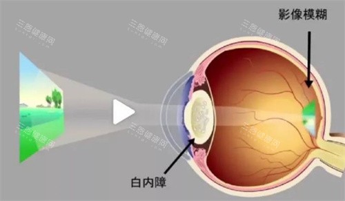 无锡白内障免费手术政策公开，2025年这些情况或可申请免费手术不容错过！