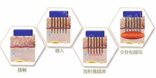 半岛第五代黄金微针多少钱?全脸6000元贵吗?对比三代四代很划算!