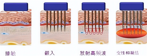 黄金微针操作过程