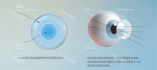 离焦软镜和ok镜的区别分析：从原理、佩戴方式、适用人群、价格等多方面对比~