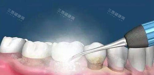 洗牙卡通示意图