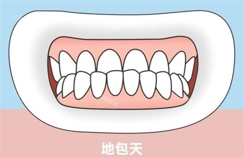 地包天示意图