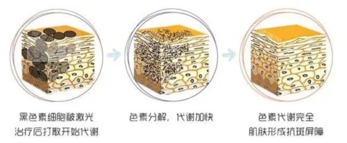 激光祛斑的原理