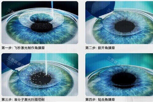 南宁爱尔眼科医院单眼近视干预病例：左右眼视力悬殊怎么办？亲身经历者分享矫正方案与术后真实体验！