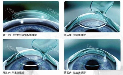 2025蚌埠眼科手术价格表全曝光：全飞秒1.5万、白内障超声乳化6千，附术后护理清单