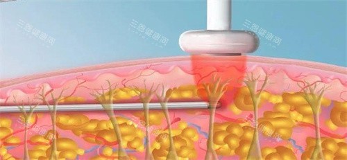 福州吸脂好的医院推荐：爱美尔/名韩/美琳达做吸脂好又靠谱