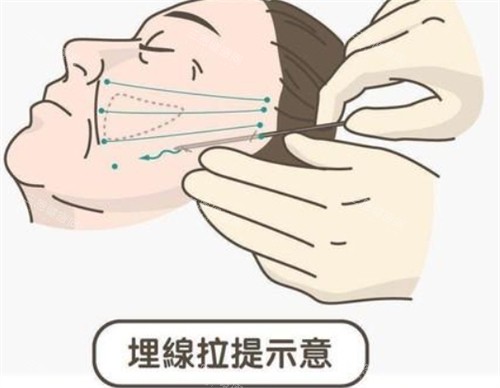 埋线提升面部的操作过程