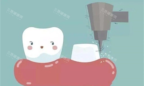 钻牙展示图