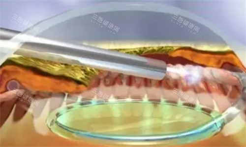 睫状体冷冻术手术步骤图解