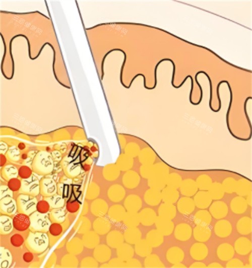 吸脂手术动画