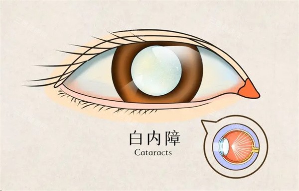 柳州做白内障手术免费政策有哪些?复明18号流动手术车项目目前正在火热推进~