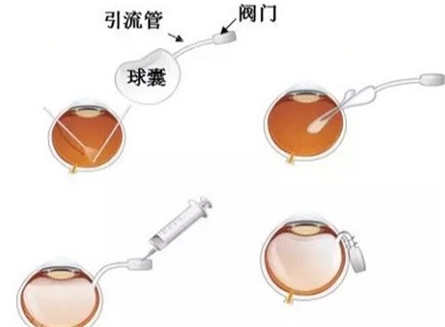 人工玻璃体植入手术
