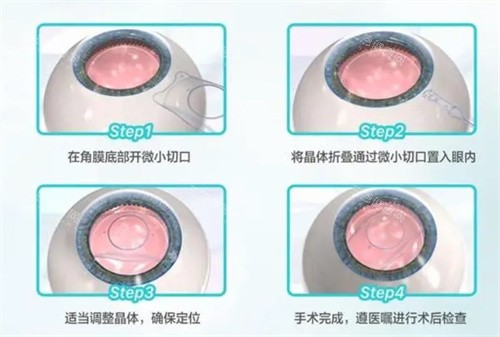 晶体植入的过程